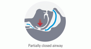Partially closed airway diagram ResMed